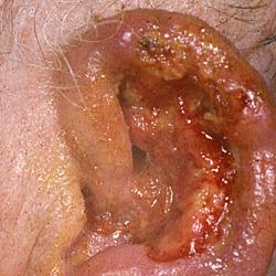 Example of skinCancer